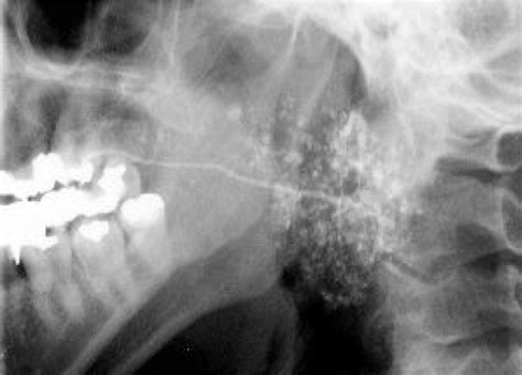 sjogren's syndrome tear test filter|sjogren's syndrome sialogram.